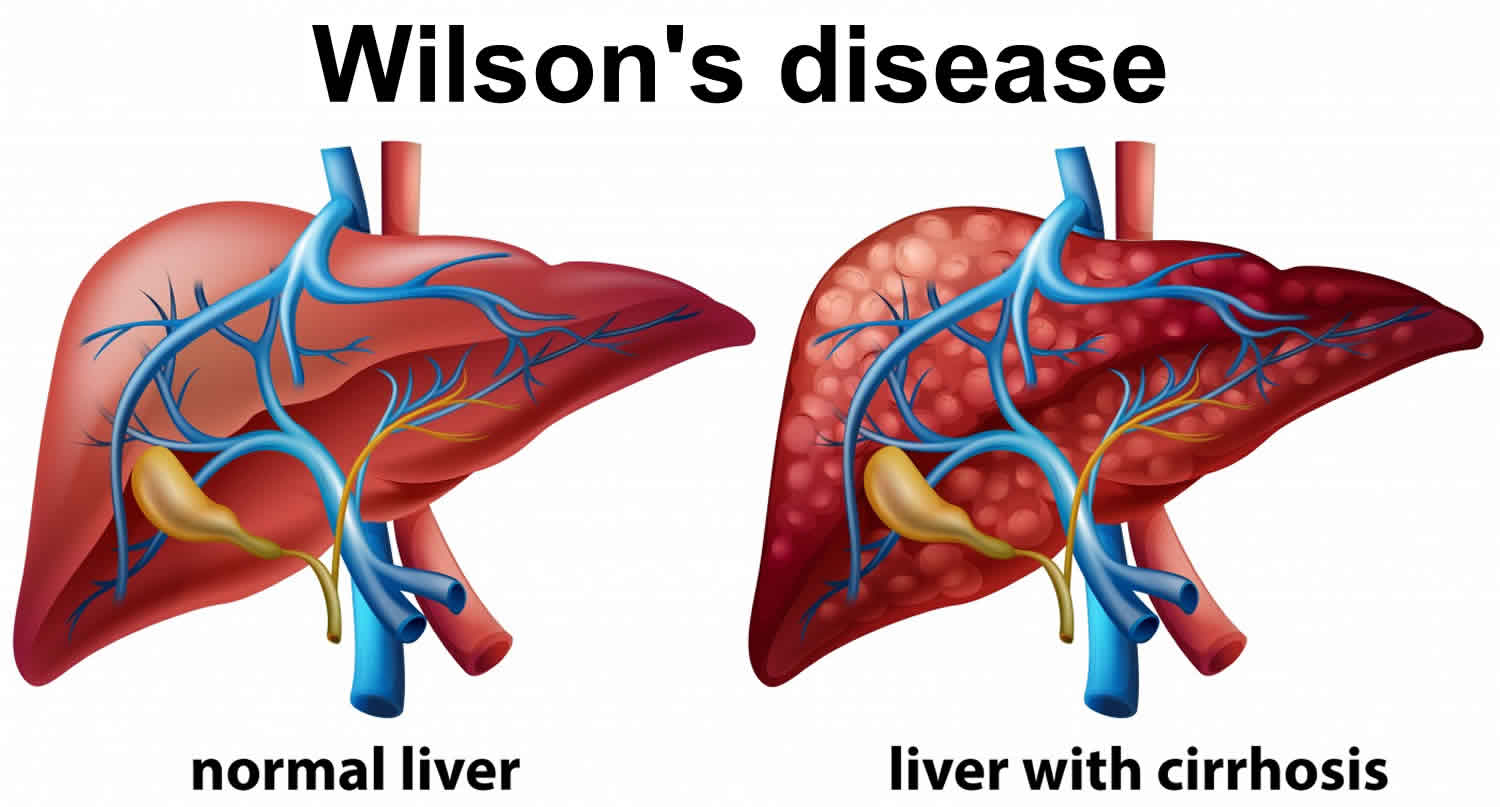Wilson's disease