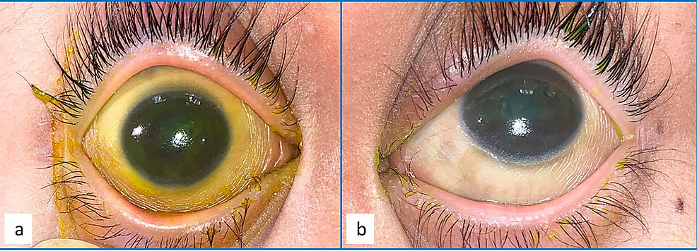 Xerophthalmia