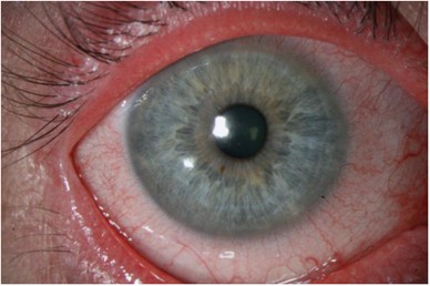 Xerophthalmia