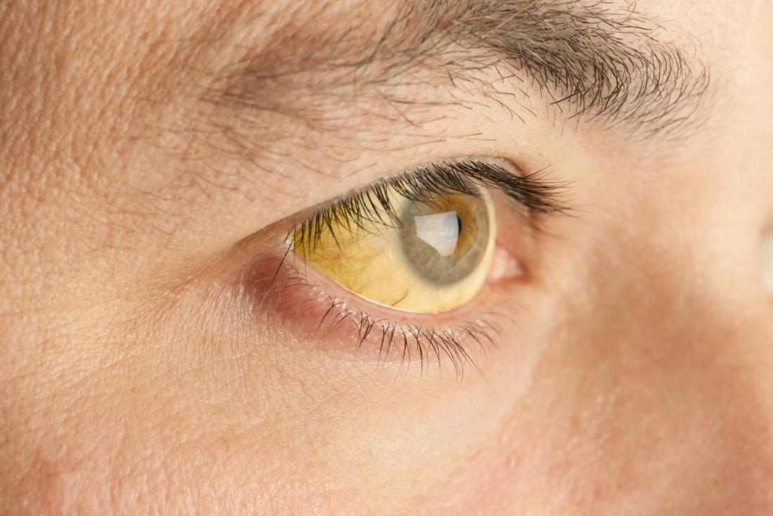 Yellow fever
