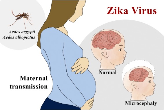 Zika virus disease
