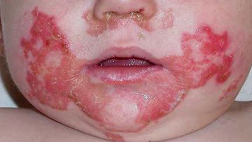 Zinc deficiency